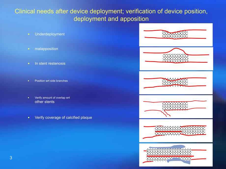 病例报告：stentboost影像增强技术指导支架置入_第3页