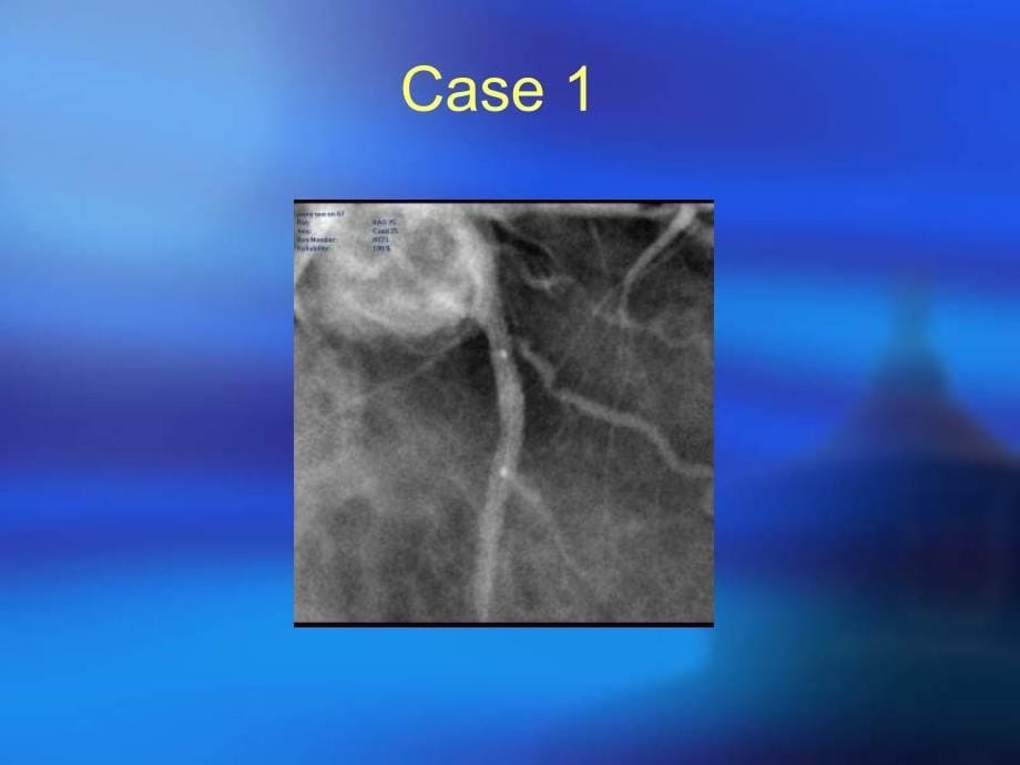 病例报告：stentboost影像增强技术指导支架置入_第5页