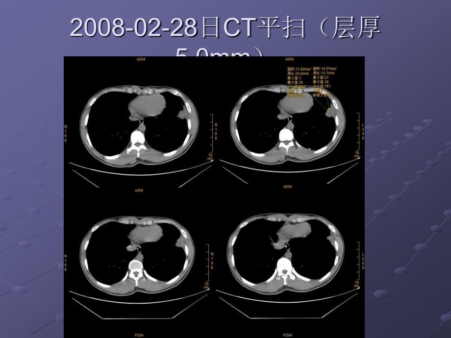 省学会心胸组读片病例_第4页