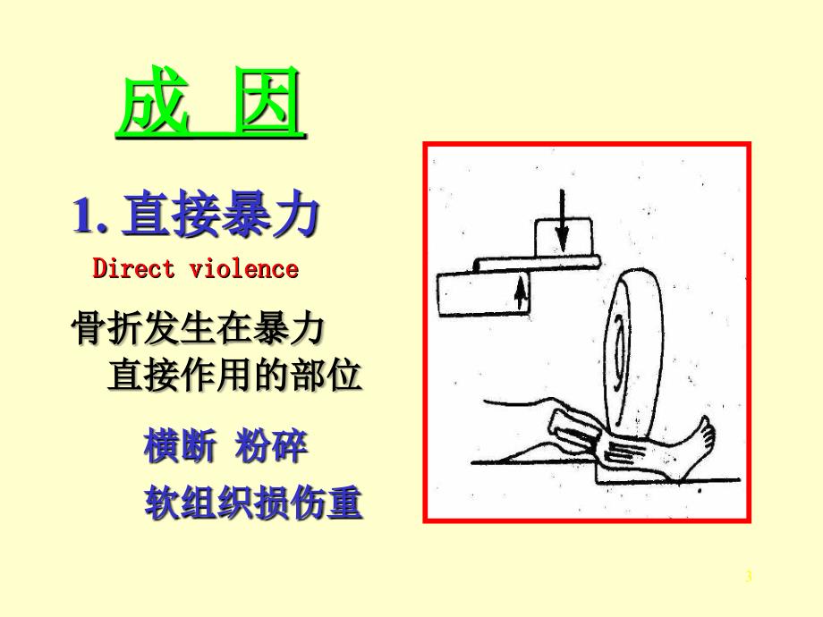 《骨折概论》ppt课件_第3页