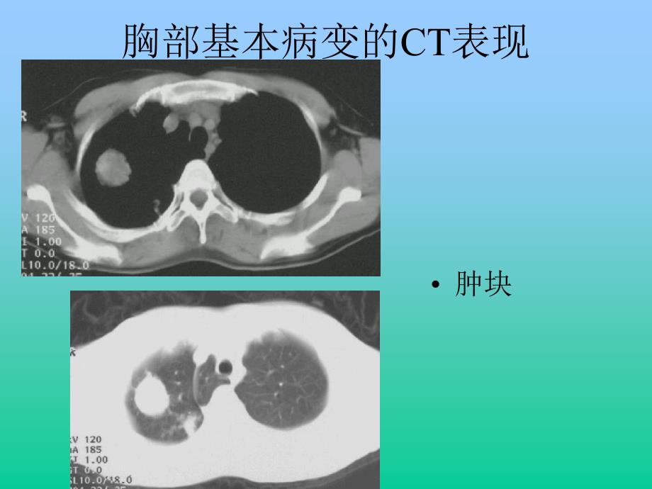 《胸部异常ct表现》ppt课件_第4页