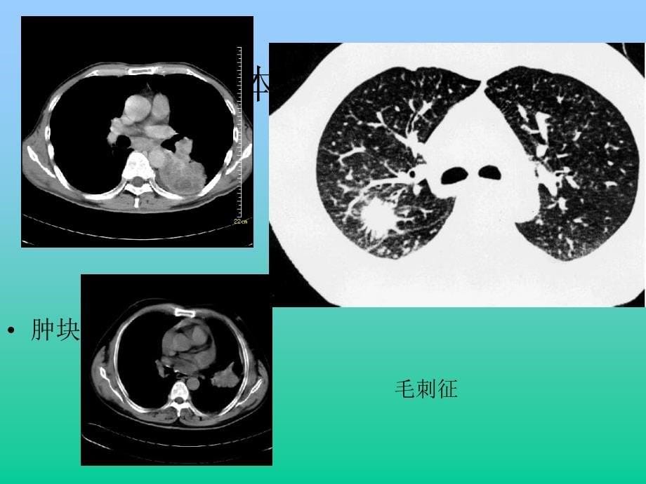 《胸部异常ct表现》ppt课件_第5页