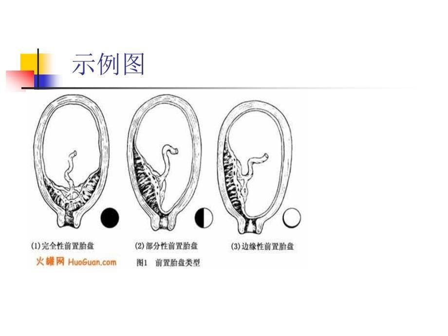 《边缘性前置胎盘》ppt课件_第5页