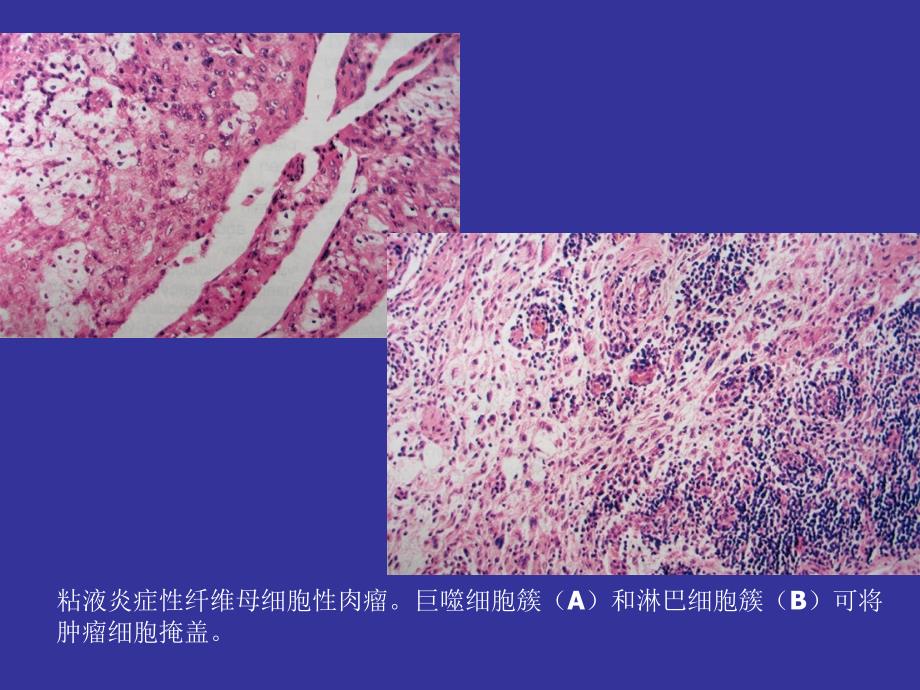 软组织肿瘤分类中的一些新的类型及病理学表现中_第4页