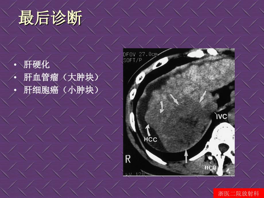 医学]临床思维和技能训练-腹部病变影像鉴别诊断_第4页