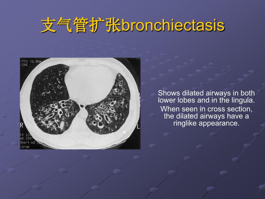 医药卫生]支气管扩张症_第4页