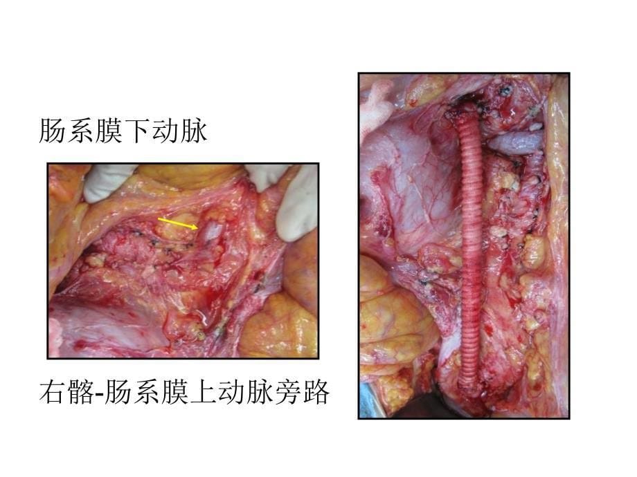 腔内和debranching技术修复白塞氏病所致的ⅳ型胸腹主动脉瘤_第5页