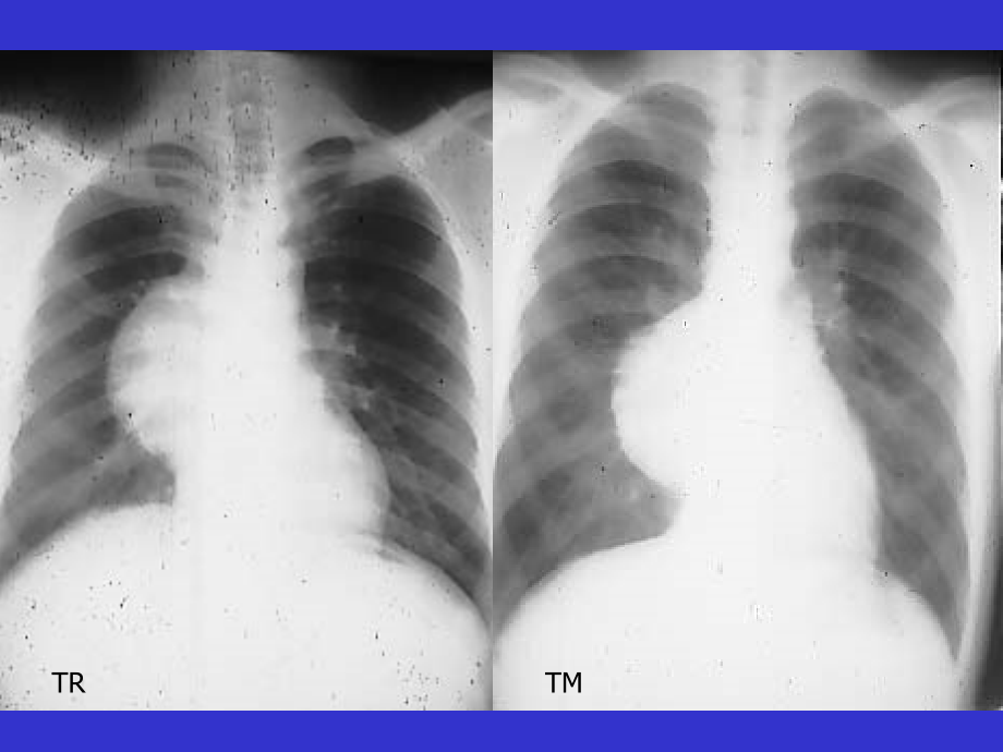 医学]纵隔肿瘤ct新_第3页