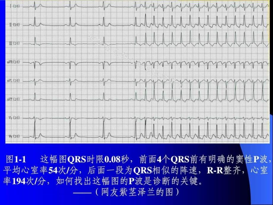 p波的识别与相关病例讨_第3页