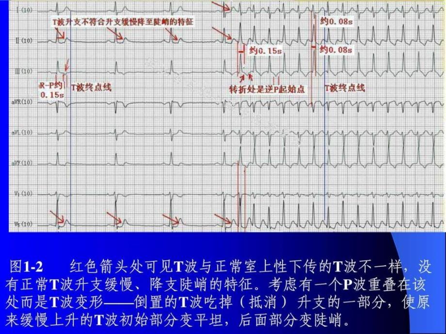 p波的识别与相关病例讨_第4页