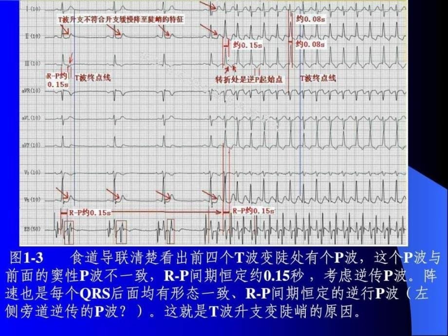 p波的识别与相关病例讨_第5页