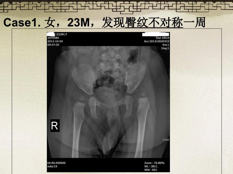 ddh____发育性髋关节脱位_第1页