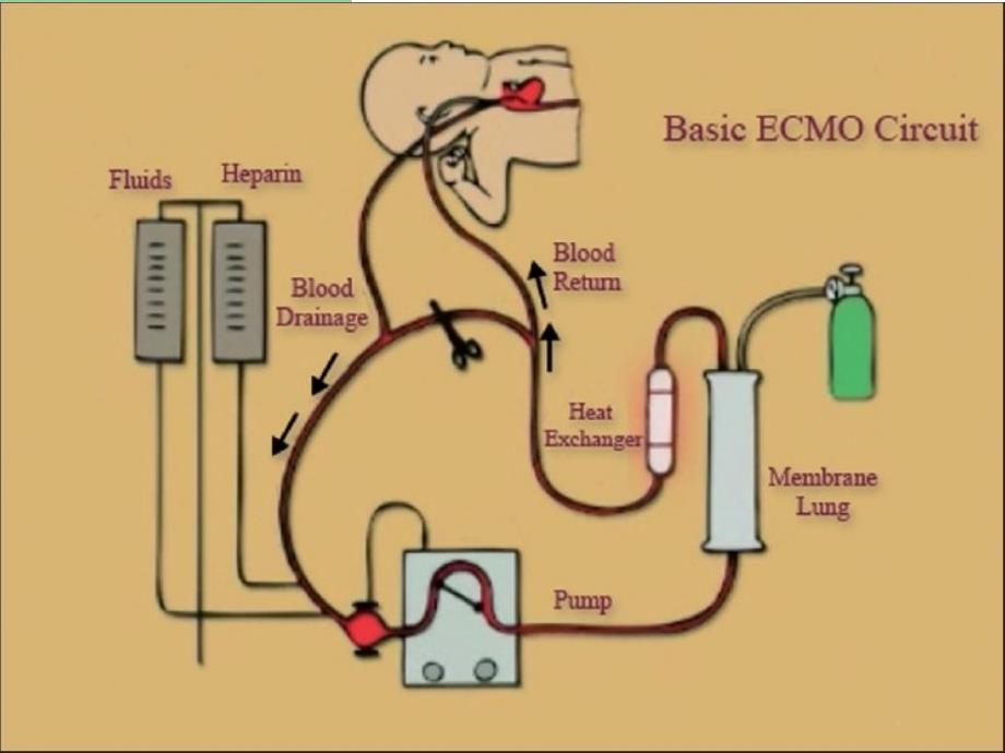 ecmo呼吸循环衰竭的应用_第3页