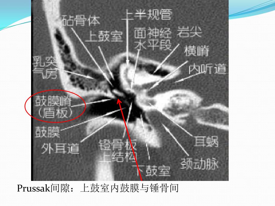 中耳乳突炎的ct诊断_第4页