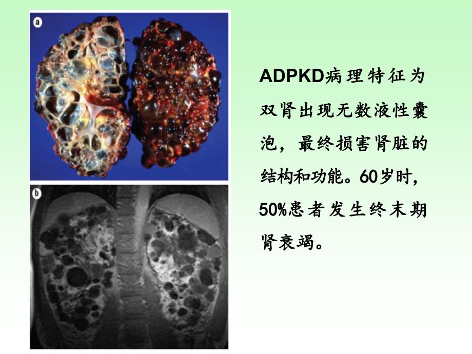 多囊肾病的发病机制及诊治进展_第4页