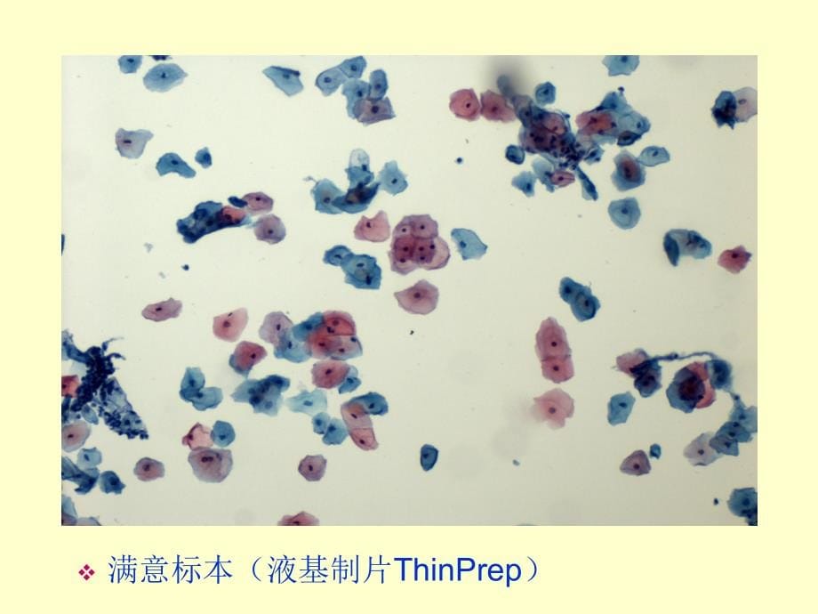 宫颈液基细胞学诊断_第5页