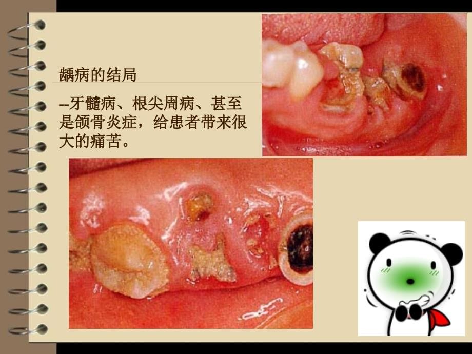 口组病第9章 龋病全面_第5页