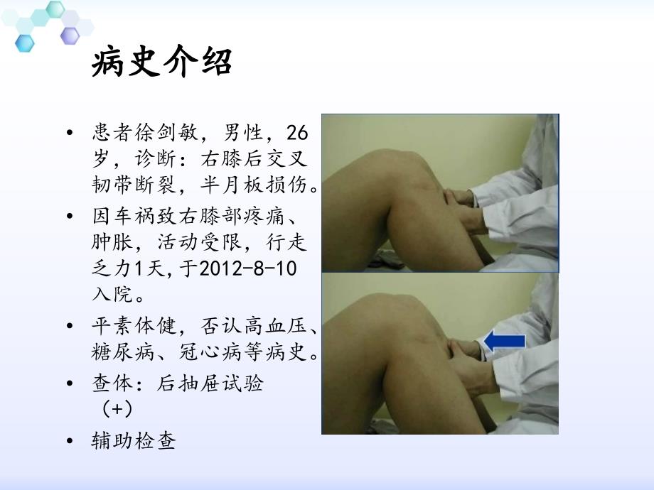 膝后交叉韧带断裂合并半月板损伤病人的护理_第3页