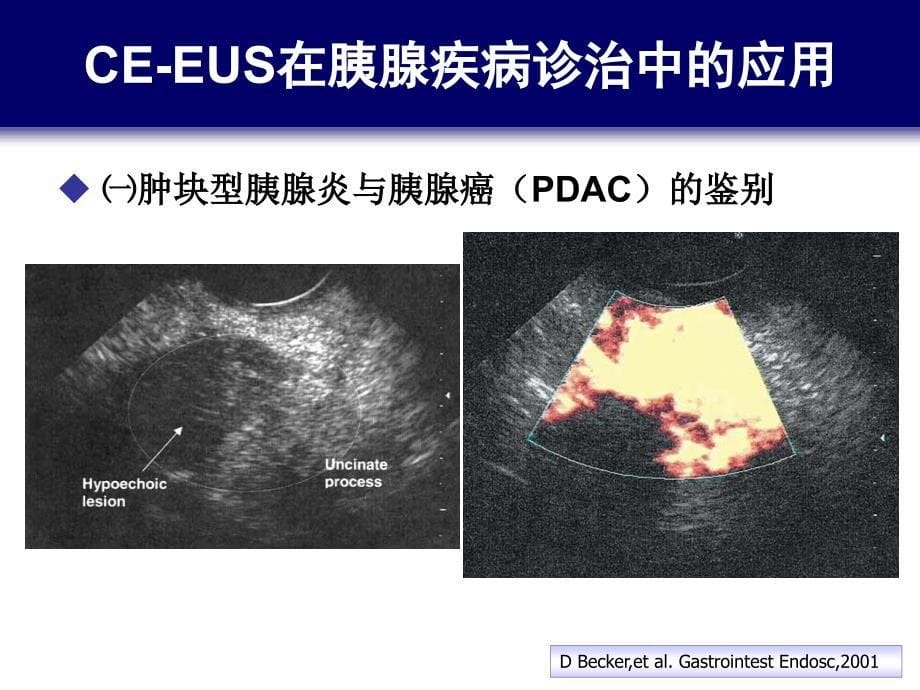 造影增强eus与胰腺疾病诊治-1_第5页