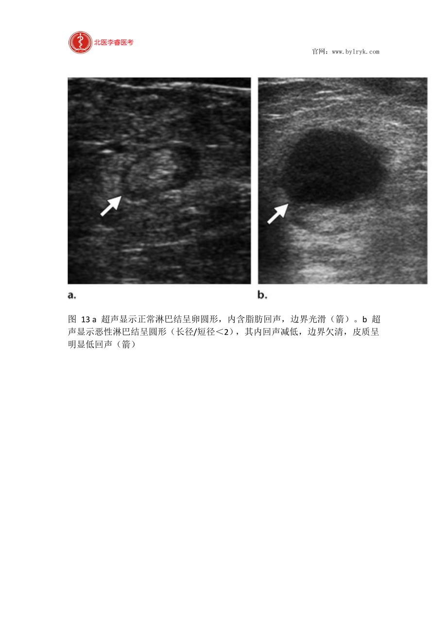 北医李睿医考妇科恶性肿瘤淋巴结转移影像评估_第4页