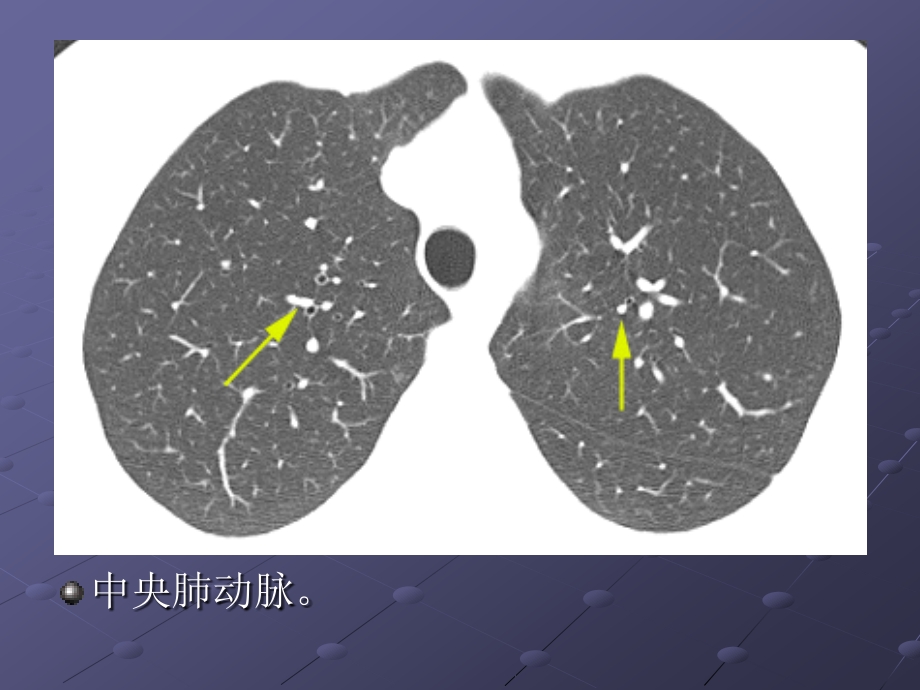 肺间质疾病影像表现_第4页