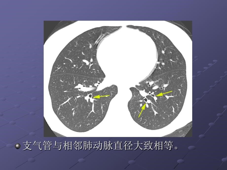 肺间质疾病影像表现_第5页