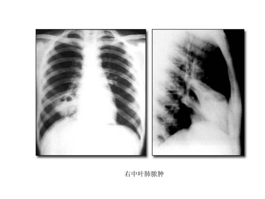 肺脓肿（lung+abscess）_第2页