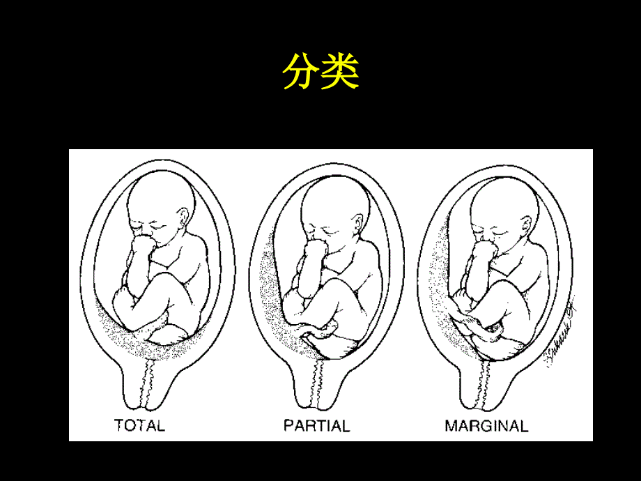 [医药卫生]前置胎盘_第4页