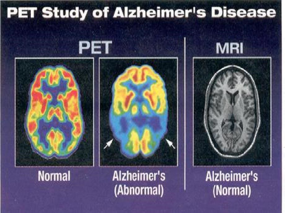 阿尔茨海默病的发病机制-2008-06-04_第5页