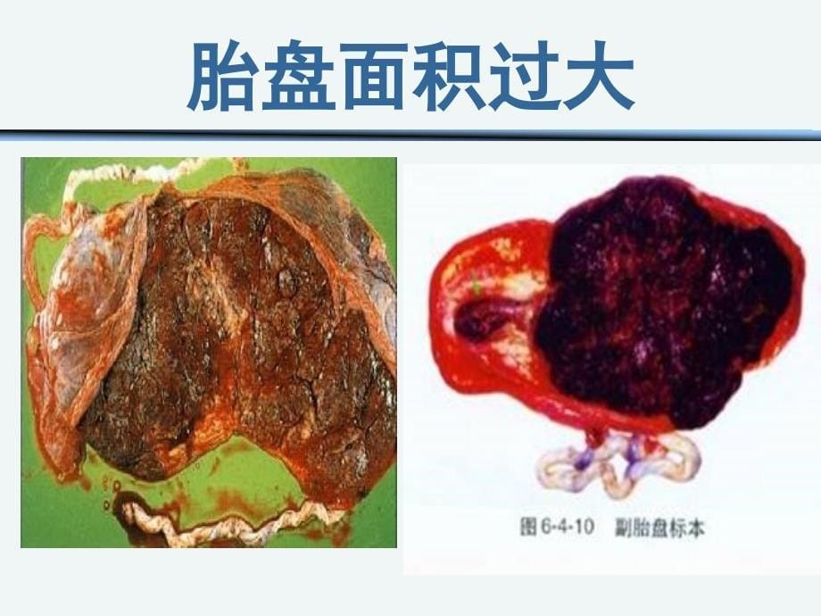 《前置胎盘的护理》ppt课件_第5页