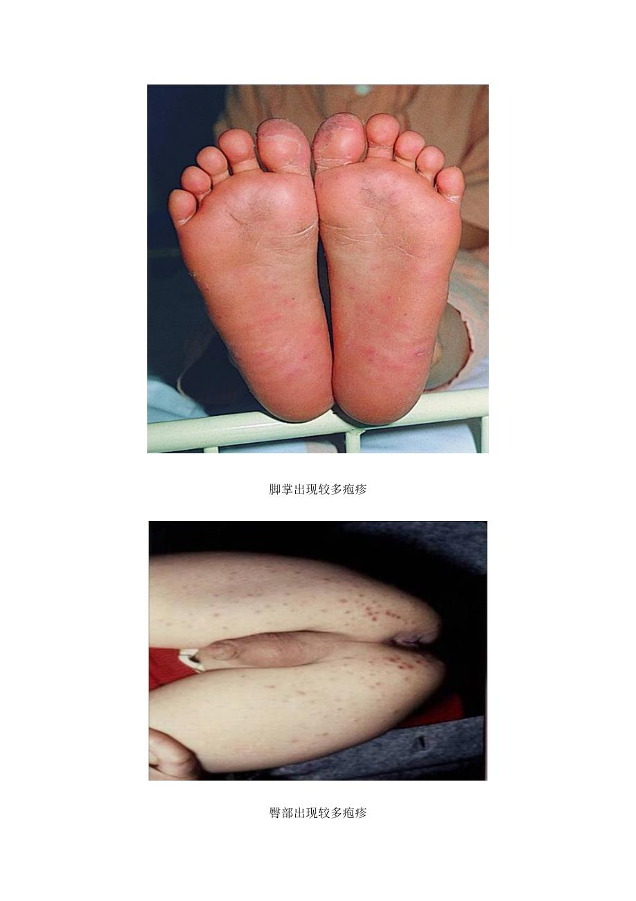 图示手足口病典型表现症状 - 万安县实验小学_第3页