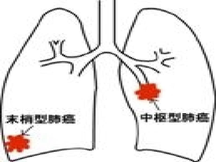 呼吸系统疾病病人的护理（5）_第5页