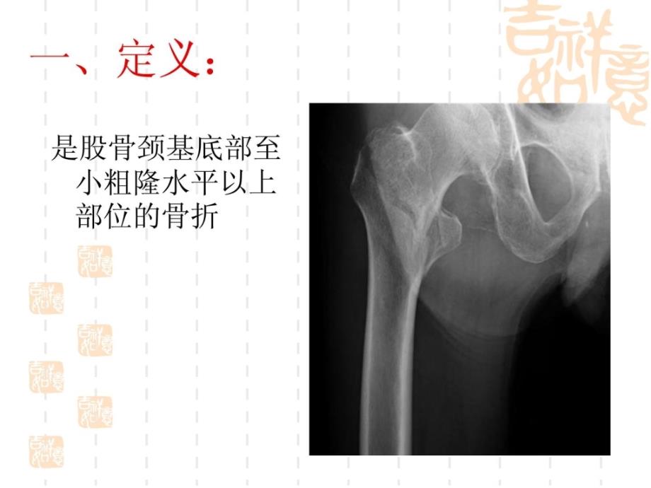 精品粗隆间骨折术后康复海内治疗停顿_第2页