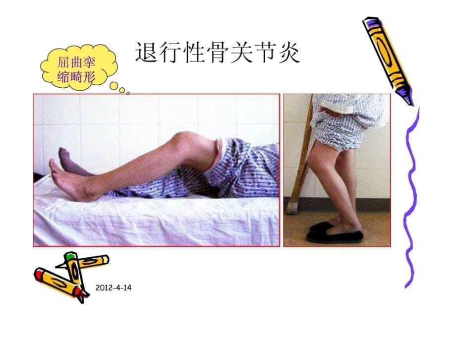 宝典人工膝关节置换术康复护理_第5页