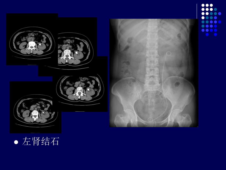 输尿管软镜治疗肾结石困难与体会_第3页