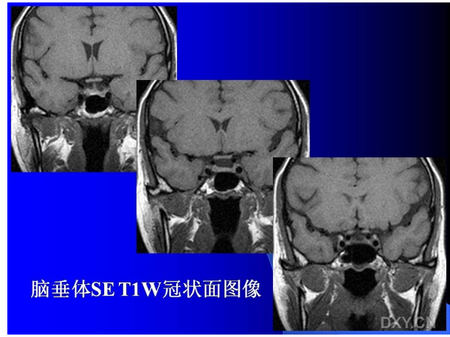 基础医学垂体瘤的mri诊断与鉴别诊断_第4页