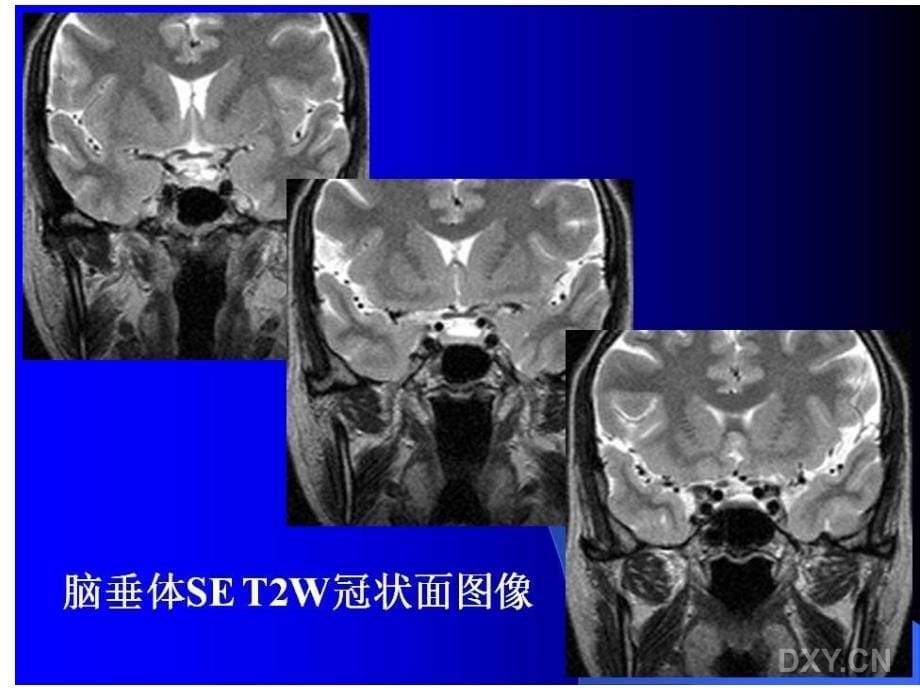 基础医学垂体瘤的mri诊断与鉴别诊断_第5页