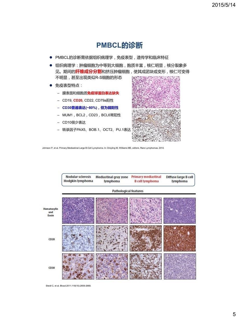 原发纵隔大b细胞淋巴瘤诊断和治疗_第5页