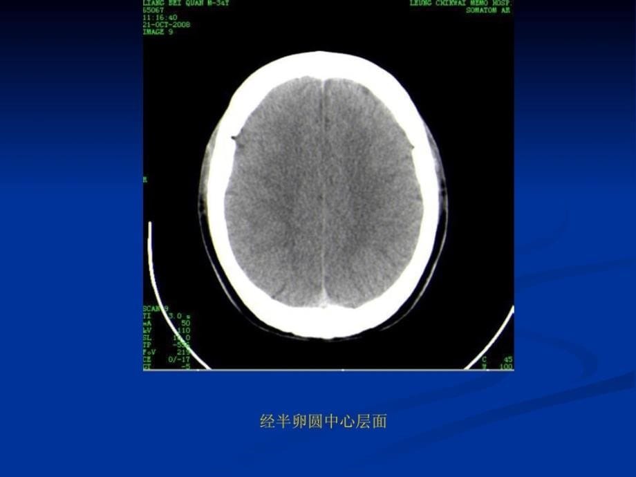 精华颅脑基础ct现象及颅脑外伤性疾病ct诊断_第5页
