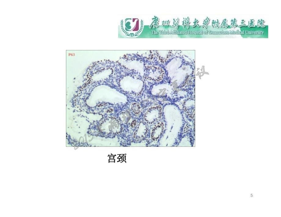 江庆萍子宫内膜化生及其临床意义_第5页