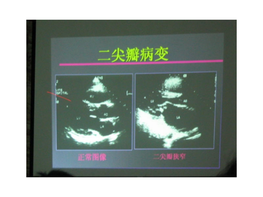 超声心动图在风心病中应用讲稿（上）_第3页