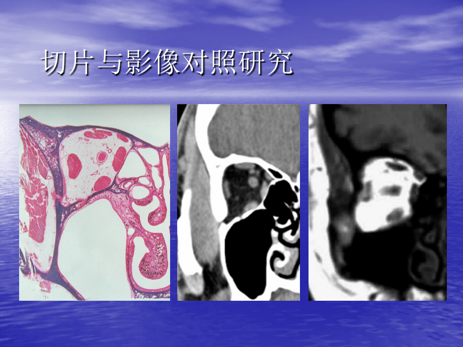 头颈部肿瘤影像诊断及鉴别_第3页