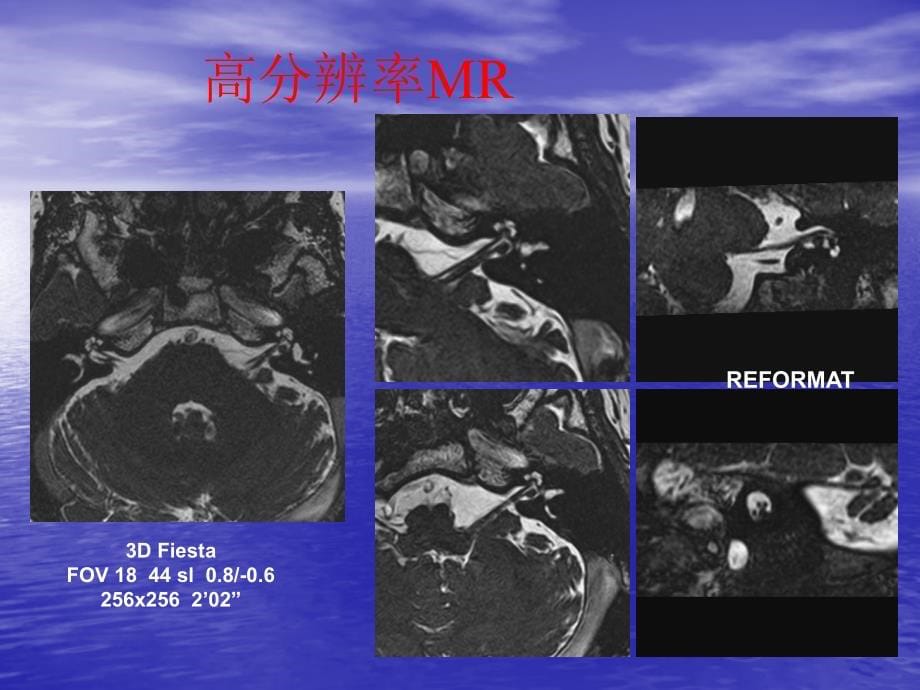 头颈部肿瘤影像诊断及鉴别_第5页