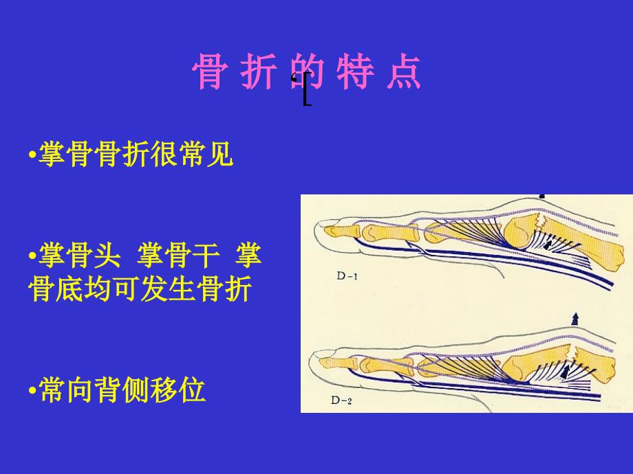 《掌骨骨折诊治》ppt课件_第4页