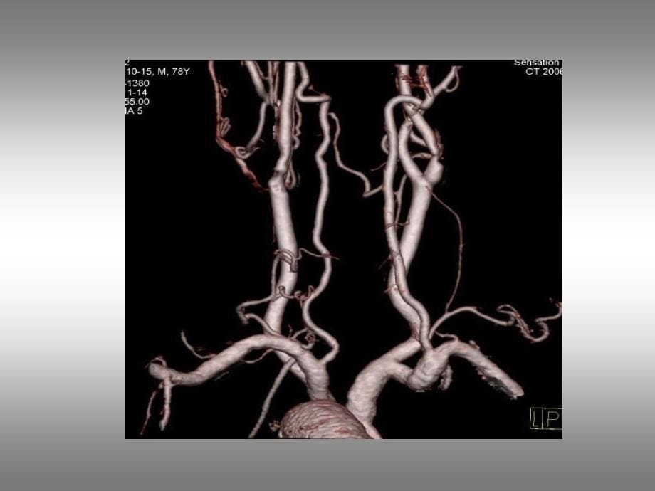 《颈部血管超声检查》ppt课件_第5页