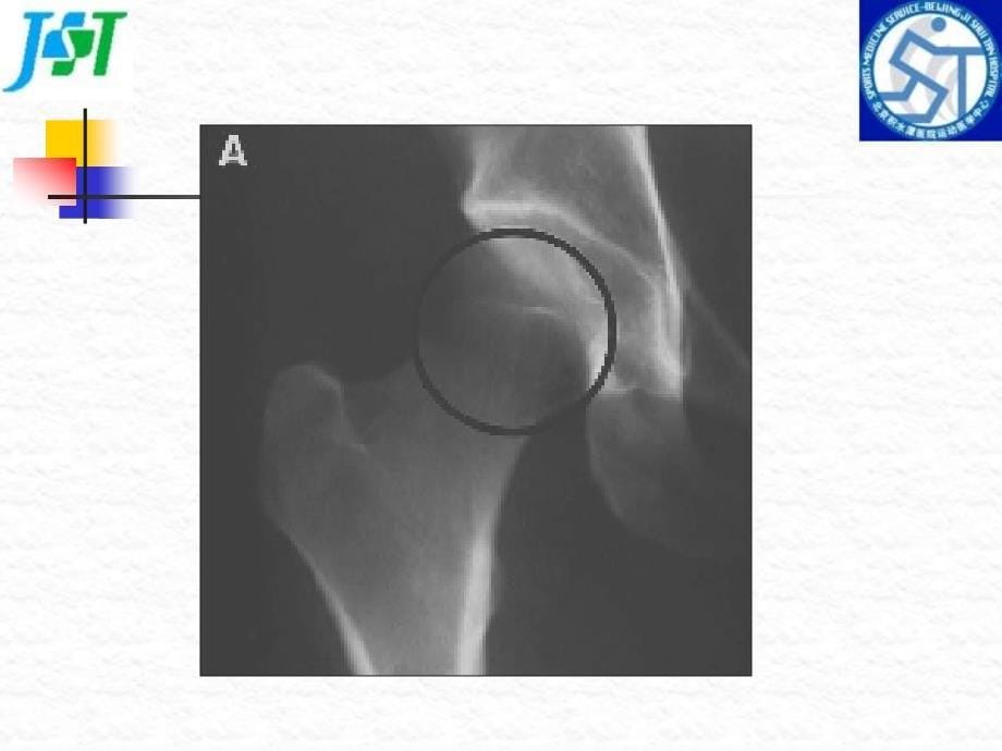 《髋臼股骨撞击》ppt课件_第5页