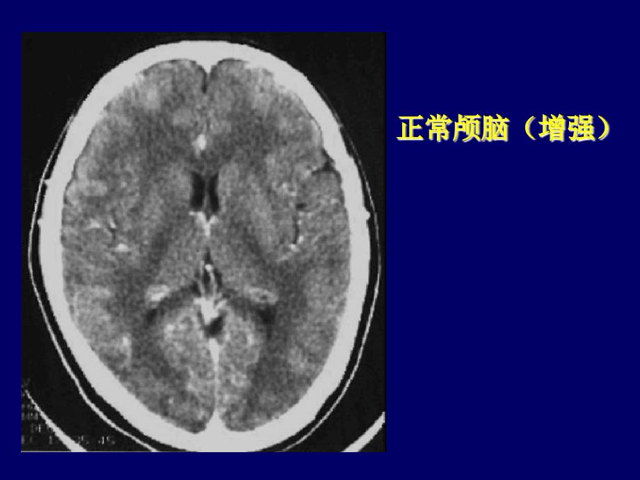 《颅脑ct诊断读》ppt课件_第3页