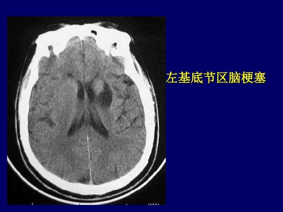 《颅脑ct诊断读》ppt课件_第5页