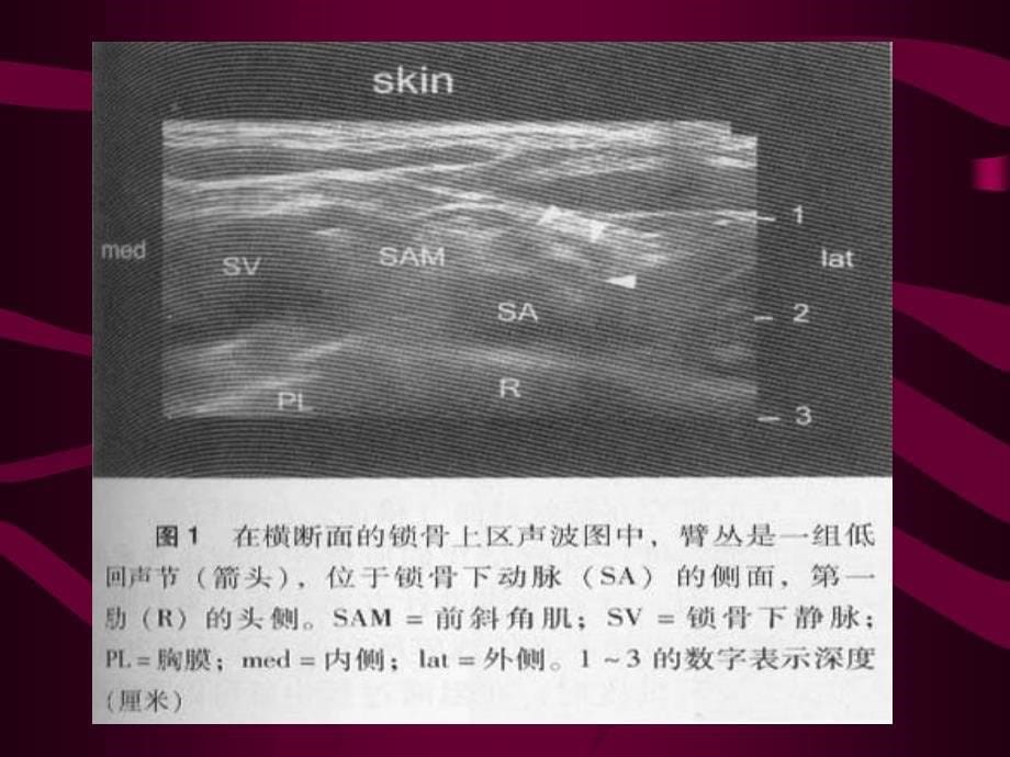 超声引导下的锁骨上臂丛神经阻滞vincentw.s.etal_第5页