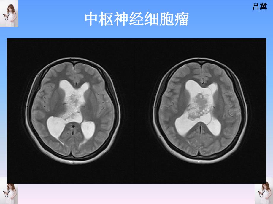 医影在线-cns疾病影像图库_第3页